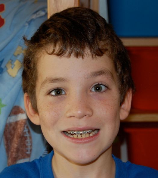 JoshuaBraces Joshua - 4th grade with braces